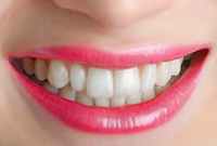 The American Dental Association recommends consulting your dentist before using any tooth bleaching product.