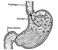 Frequent heartburn can be a symptom of a more serious problem called Gastroesophageal Reflux Disease or GERD